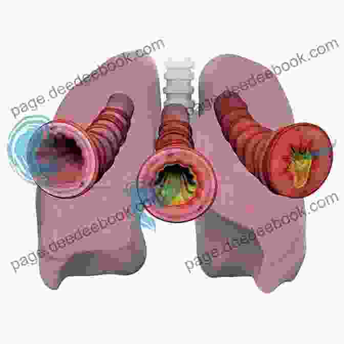 Microscopic View Of An Asthmatic Lung Bronchial Asthma Miniatlas Rod J Rohrich